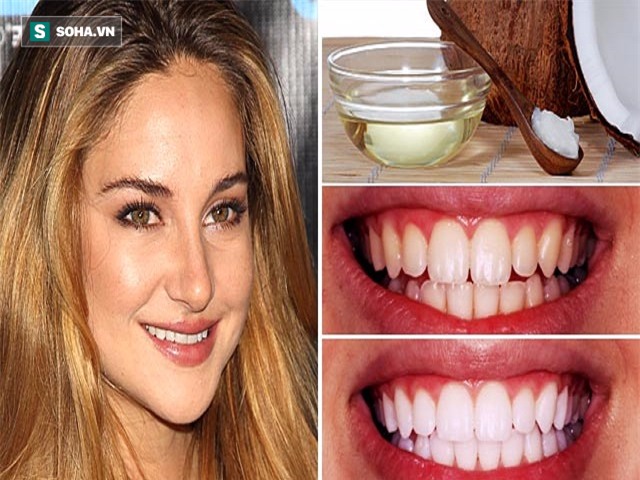 4 phương pháp giúp răng trắng lên trông thấy chỉ trong 7 ngày mà không cần gặp bác sĩ - Ảnh 1.