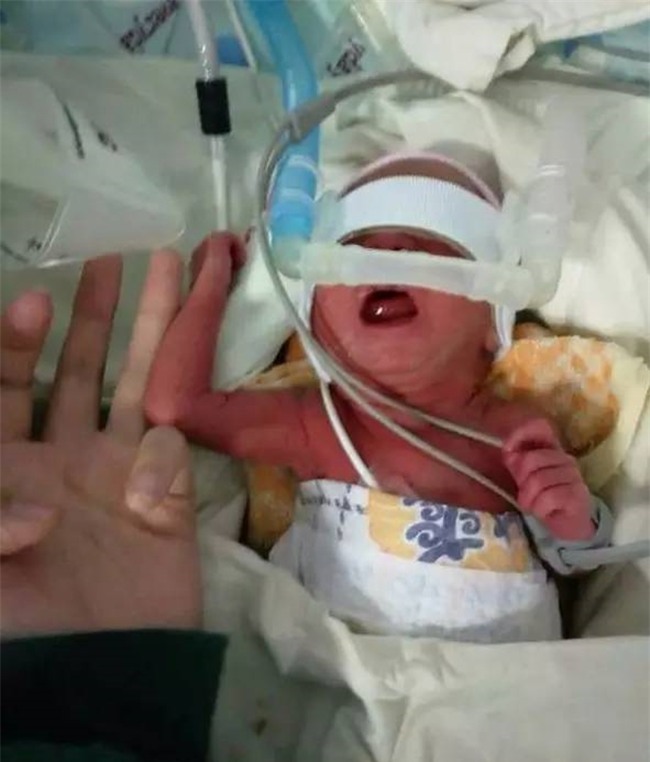 Chỉ nặng 950g và nằm lọt thỏm trong lòng bàn tay người lớn, đứa trẻ này vẫn sống sót kỳ diệu - Ảnh 2.