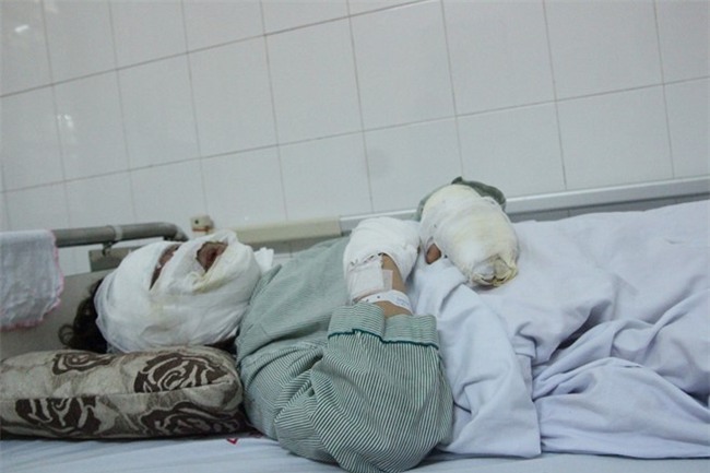 Hai co gai bi bong toan bo khuon mat do bong bay phat no hinh anh 1