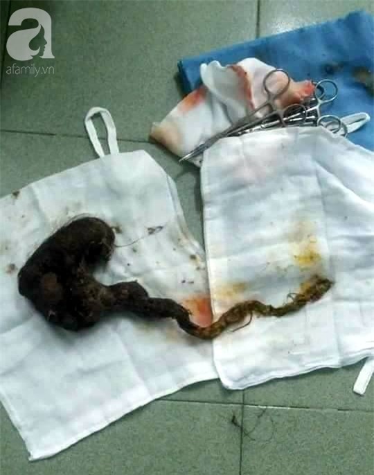 Phát hiện búi tóc dài hơn 40cm trong dạ dày bé trai mắc hội chứng “công chúa tóc dài” - Ảnh 1.