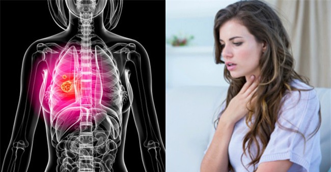 Triệu chứng này của bệnh ung thư phổi thường xuất hiện ở giai đoạn đầu nhưng rất khó nhận ra - Ảnh 1.