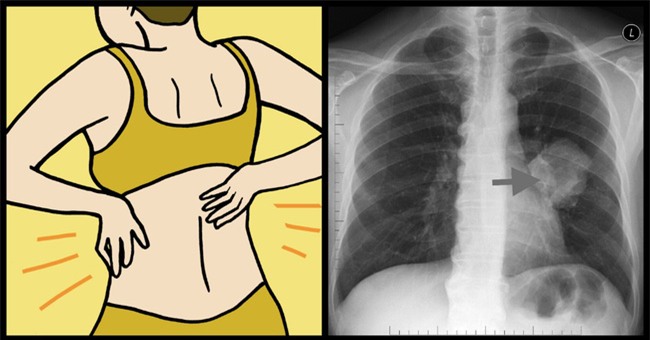 Triệu chứng này của bệnh ung thư phổi thường xuất hiện ở giai đoạn đầu nhưng rất khó nhận ra - Ảnh 3.