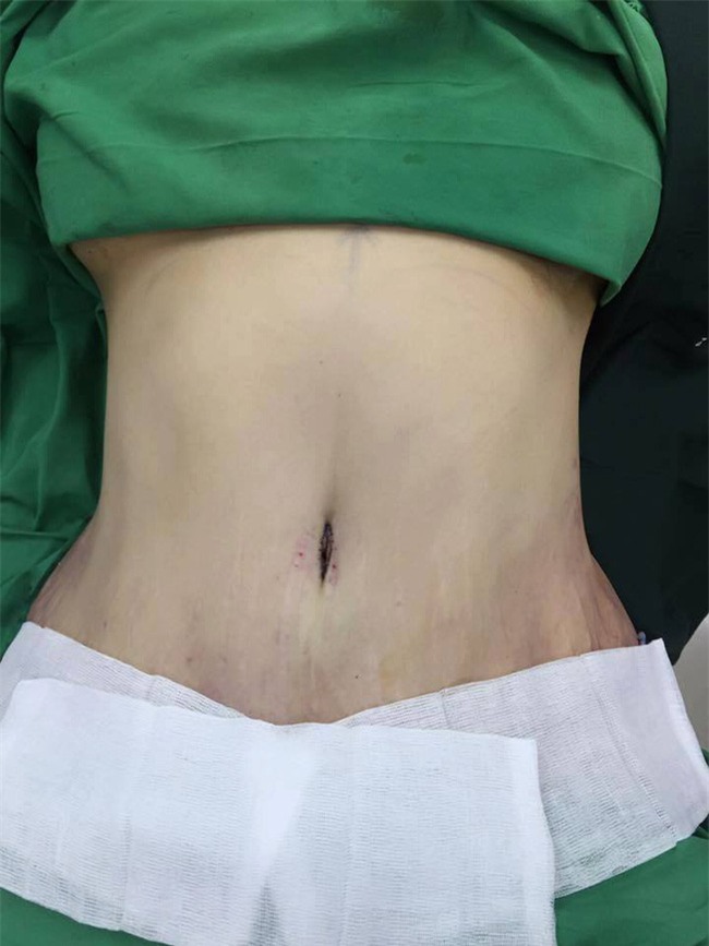 Xót xa mẹ 1 con đại phẫu làm đẹp hút mỡ bụng, nâng mũi, sửa mặt mặt để... dự đám cưới chồng cũ - Ảnh 1.