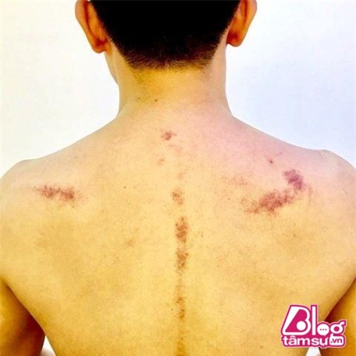 hari1 blogtamsuvn (1) (Custom)