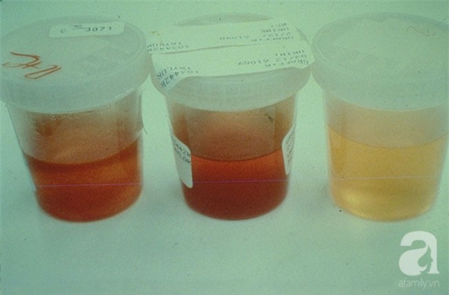 Bệnh viêm cầu thận khiến 2 học sinh ở Nghệ An tử vong nguy hiểm như thế nào? - Ảnh 2.