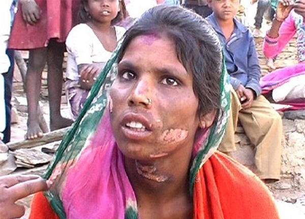 Ấn Độ: Nàng dâu trẻ bị gia đình chồng tra tấn dã man vì một cuộc gọi lỡ - Ảnh 1.