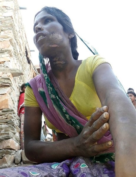 Ấn Độ: Nàng dâu trẻ bị gia đình chồng tra tấn dã man vì một cuộc gọi lỡ - Ảnh 2.