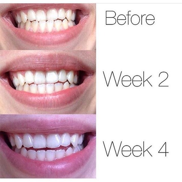 3 sản phẩm làm trắng răng rất tiện dụng bạn nên thử ngay tại nhà - Ảnh 10.