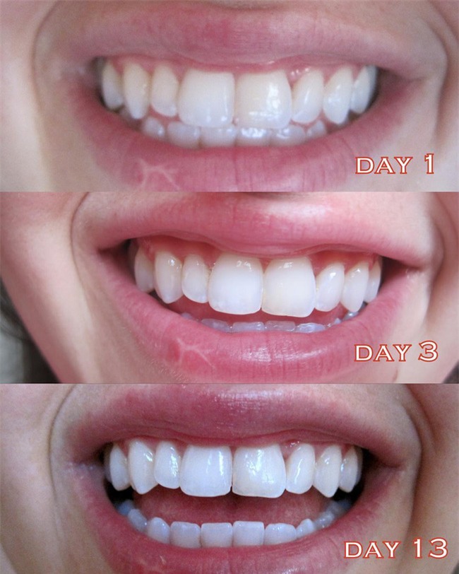 3 sản phẩm làm trắng răng rất tiện dụng bạn nên thử ngay tại nhà - Ảnh 6.