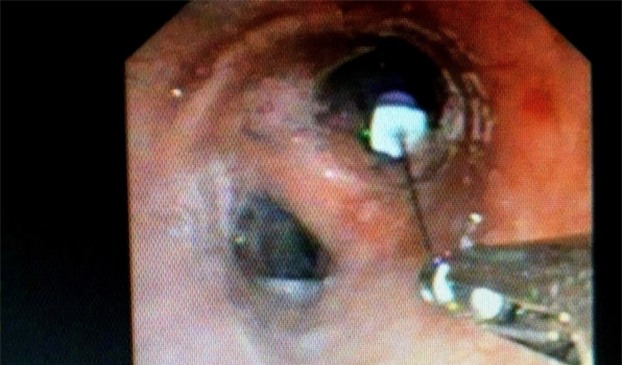 Di lay tuy rang, benh nhan nuot luon cay kim vao phoi