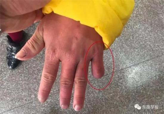 Bé gái 12 tuổi bị mẹ đẻ dùng kéo cắt ngón tay, châm thuốc lá đốt da - Ảnh 1.