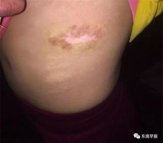 Bé gái 12 tuổi bị mẹ đẻ dùng kéo cắt ngón tay, châm thuốc lá đốt da - Ảnh 2.