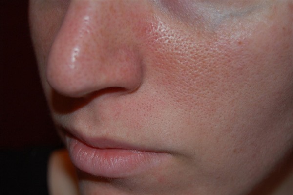 Kiên trì thực hiện các bước chăm sóc này, lỗ chân lông có to như nào cũng được se khít nhanh chóng - Ảnh 2.