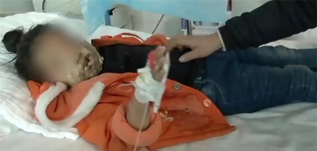 Bé gái 4 tuổi bị biến dạng khuôn mặt vì điện thoại của cha nổ khi đang sạc - Ảnh 1.