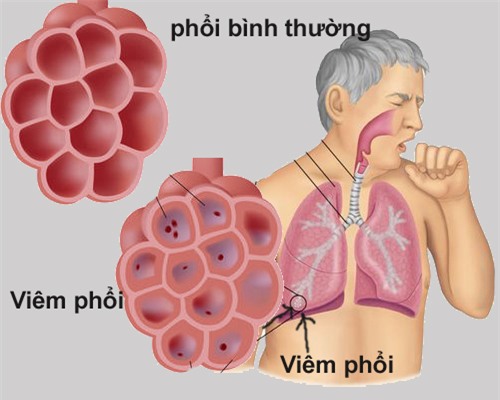 8 dấu hiệu của bệnh viêm phổi bạn không nên bỏ qua - Ảnh 1.