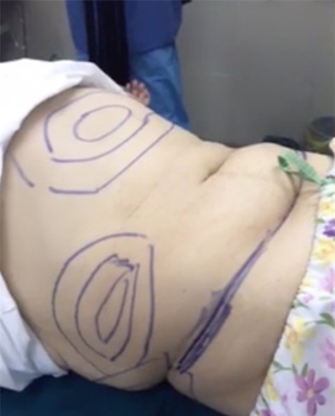 giảm cân, hút mỡ bụng, cắt mỡ bụng, Ngô Thuỷ Tiên, bước nhảy ngàn cân