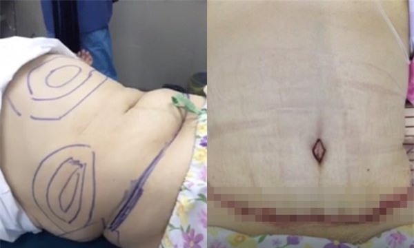 giảm cân, hút mỡ bụng, cắt mỡ bụng, hút mỡ