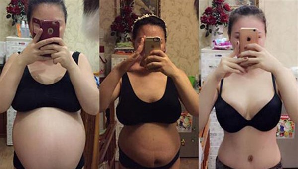 giảm cân, hút mỡ bụng, cắt mỡ bụng, hút mỡ