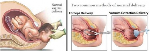 sinh thường, sinh mổ, so sánh sinh thường và sinh mổ, ưu điểm của sinh mổ, nhược điểm của sinh mổ, ưu điểm của sinh thường, nhược điểm của sinh thường, so sánh sinh thường và sinh mổ