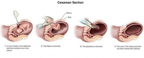 sinh thường, sinh mổ, so sánh sinh thường và sinh mổ, ưu điểm của sinh mổ, nhược điểm của sinh mổ, ưu điểm của sinh thường, nhược điểm của sinh thường, so sánh sinh thường và sinh mổ