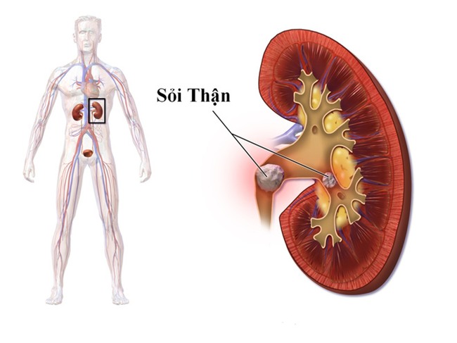 Mỗi người chỉ có hai quả thận: Hãy cảnh giác với căn bệnh âm thầm làm hỏng thận này! - Ảnh 2.