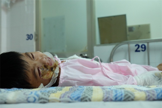 Thương tâm bé trai 5 tuổi bị điện giật khiến hoại tử nặng hai bàn tay - Ảnh 5.