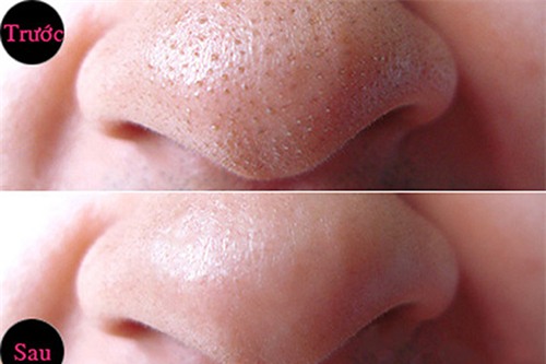 lot sach mun cam, mun dau den chi bang nam la nay xay nhuyen - 4