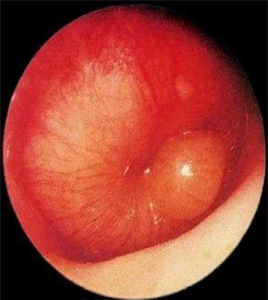 Me bat xi mui, con bi viem phong do tai giua hinh anh 1