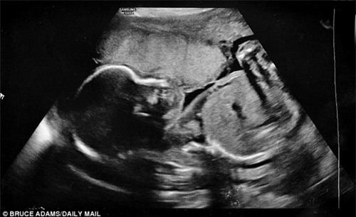 thai nhi gap nan, me uong 4 lit nuoc moi ngay va ket qua khong the ngo - 3