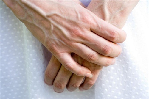 Nổi tĩnh mạch trên cơ thể là dấu hiệu bệnh gì? Đây chính là những gợi ý giúp bạn nhận biết - Ảnh 1.