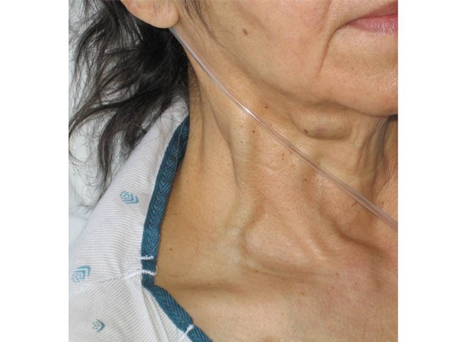 Nổi tĩnh mạch trên cơ thể là dấu hiệu bệnh gì? Đây chính là những gợi ý giúp bạn nhận biết - Ảnh 4.