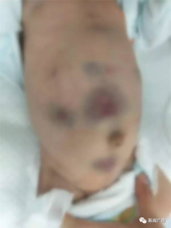 Bé sơ sinh 40 ngày tuổi bị đâm 30 mũi kim vì bà ngoại tin bài thuốc dân gian chích máu - Ảnh 2.