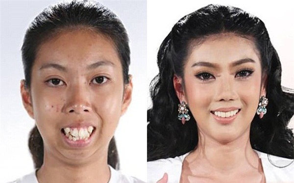 Màn vịt hóa thiên nga ngoạn mục của cô gái Thái không cằm, răng hô khiến dân tình sửng sốt - Ảnh 2.