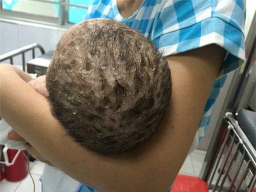 tam la chua thuy dau, be trai 4 thang tuoi bi nhiem doc da toan than - 1