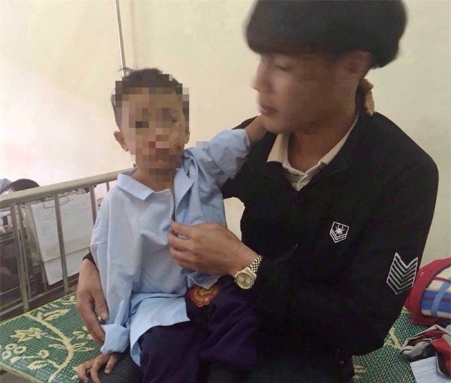 Hai anh em bi no nat tay khi dot pin dien thoai hinh anh 1