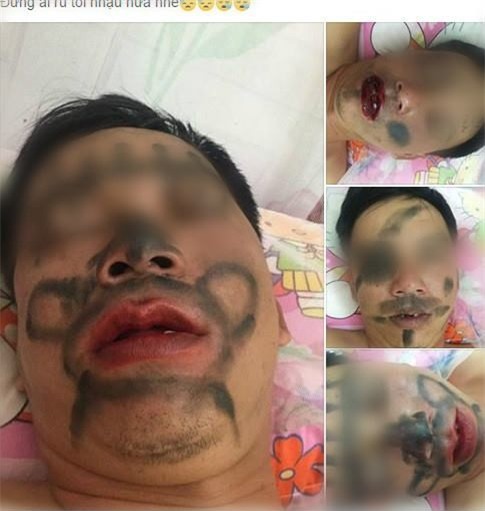 Người vợ vẽ chằng chịt lên mặt chồng vì nhiều lần nhậu say - Ảnh 1.