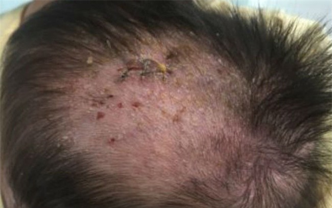 Trẻ bị chốc đầu đừng nghĩ là cứt trâu mà có thể mắc căn bệnh đáng sợ này - Ảnh 1.