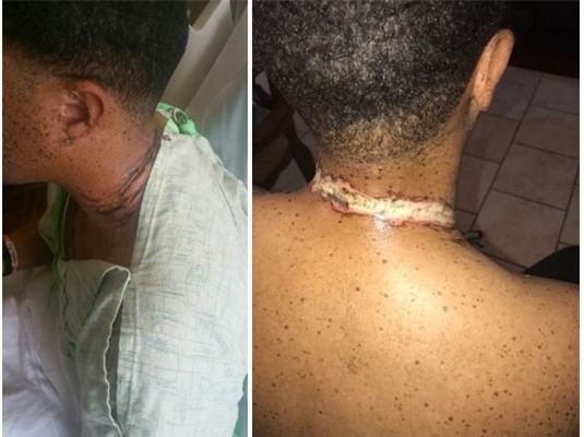 Vết bỏng trên cổ của Wiley Day