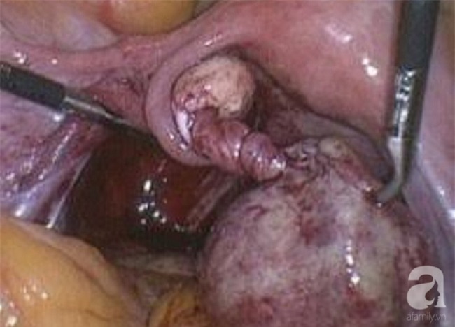 Bị đau bụng cấp, chị em đừng chủ quan nghĩ là do kinh nguyệt mà coi chừng bị căn bệnh nguy hiểm này - Ảnh 2.