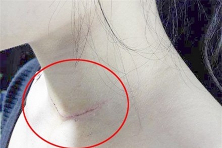 Vết thương trên cổ nạn nhân. Ảnh: CTV.