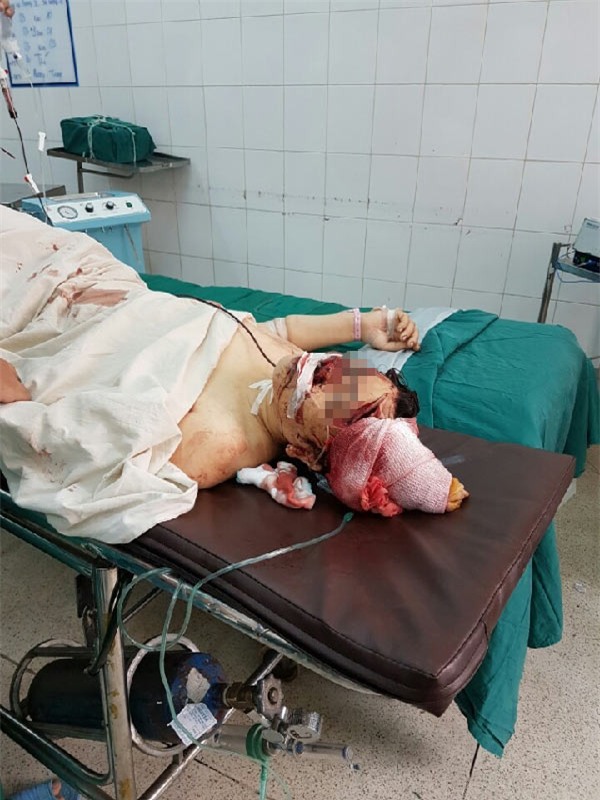 nghi an chong chem vo vo so nao roi cua co tu sat hinh anh 1