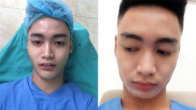 Chàng trai gây sốc khi công khai quá trình thẩm mỹ đau đớn, sửa, sửa nữa, sửa mãi vì tự ti - Ảnh 3.