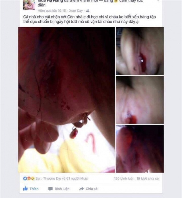 Hình ảnh tai cháu Ngọc chảy máu do gia đình đăng tải trên mạng xã hội.