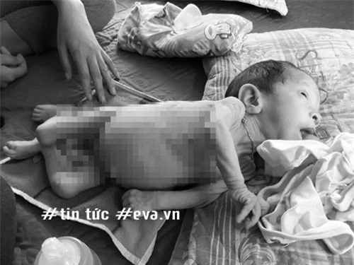 xot thuong be gai 6 thang tuoi nang 3,2kg, khong len lang nao tu luc sinh ra - 1