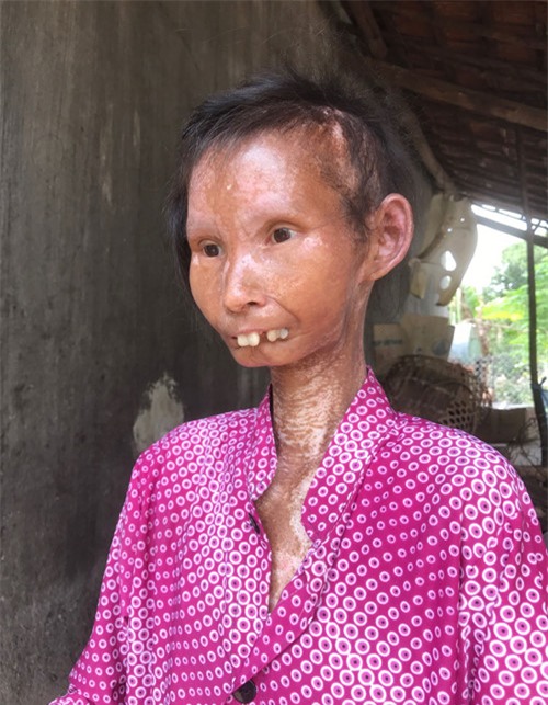Chị Ninh Thi Nâu biến thành một con người khác từ ngày bệnh. Ảnh: Tâm Ngọc