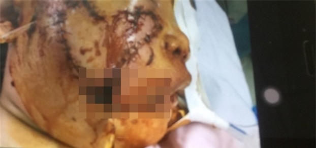 Thuong tam be gai 5 tuoi bi cho can nat nua khuon mat, lo ca hai ham rang