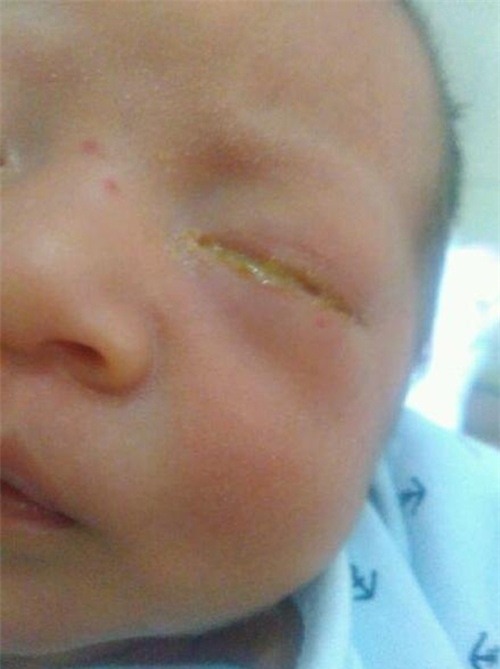 nguoi me soc nang khi biet nguyen nhan mat con nho sung hup, chay mu - 1