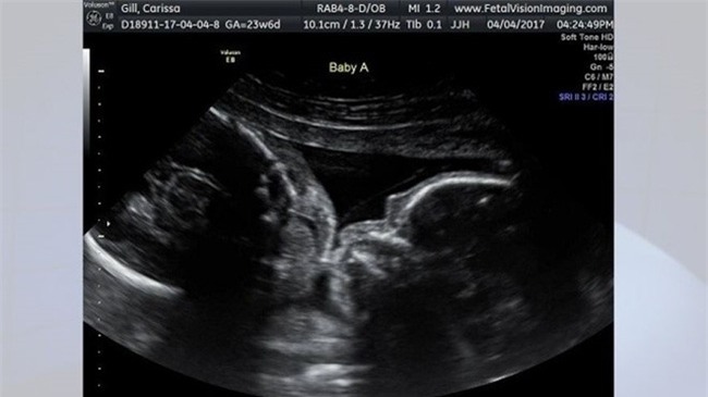 Cặp song sinh hôn nhau trong bụng mẹ - Ảnh 1.