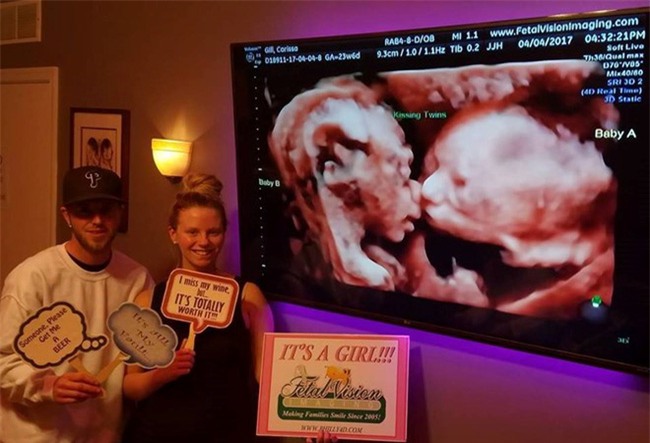 Cặp song sinh hôn nhau trong bụng mẹ - Ảnh 2.