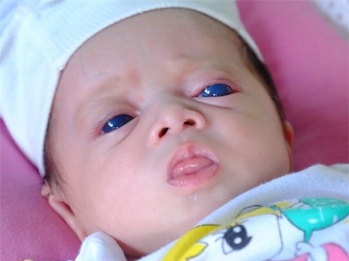 Bé gái mới chào đời với đôi mắt xanh đục khiến nhiều người ngỡ ngàng. Ảnh: VnExpress